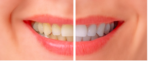 Teeth Whitening Difference